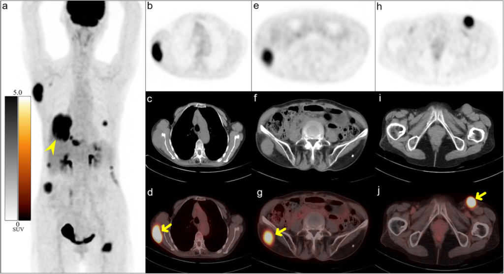 FDG Pet Scan