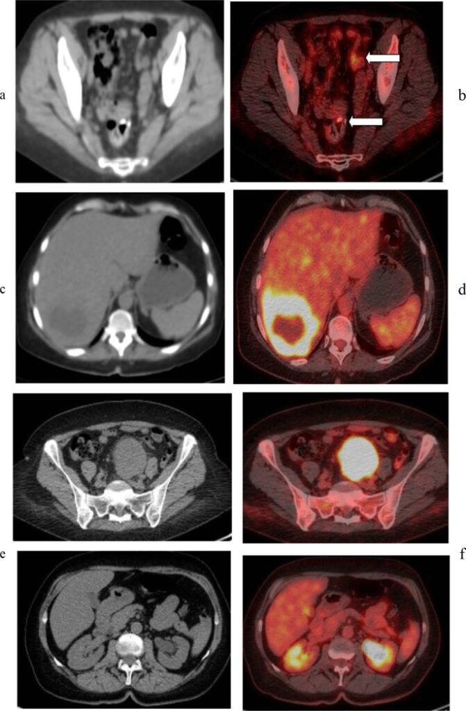 Whole Body Pet Scan For Cancer