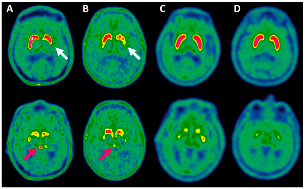 Dopa pet CT Scan