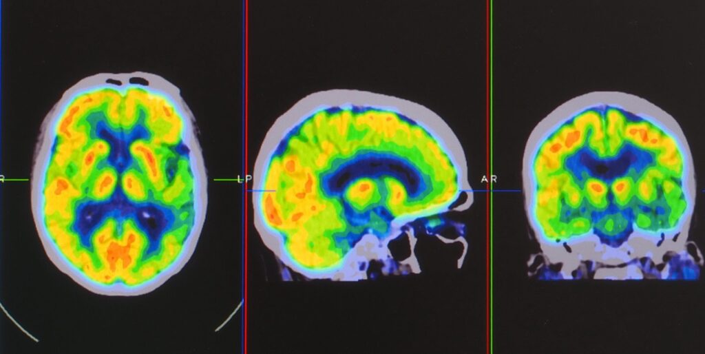 Positron Emission Tomography | Positron Emission Tomography In Delhi